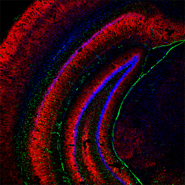 Alzheimer, una nuova strategia per prevenire la neurodegenerazione