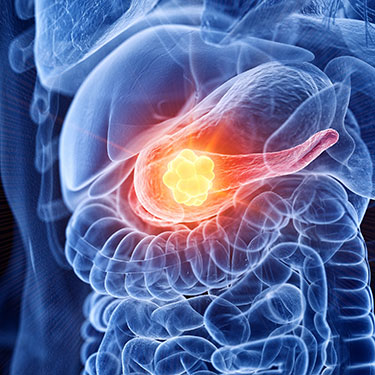 Tumore del pancreas, scoperto meccanismo di resistenza alla terapia