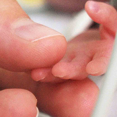 Trisomia 21, anche una reazione autoimmune dietro la Sindrome di Down